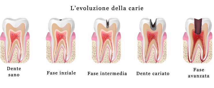 evoluzione carie dentali
