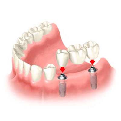 esempio di protesi dentale fissa